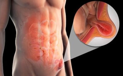 Diagnóstico y Tratamiento de la Hernia Inguinal: Guía para Profesionales de la Salud