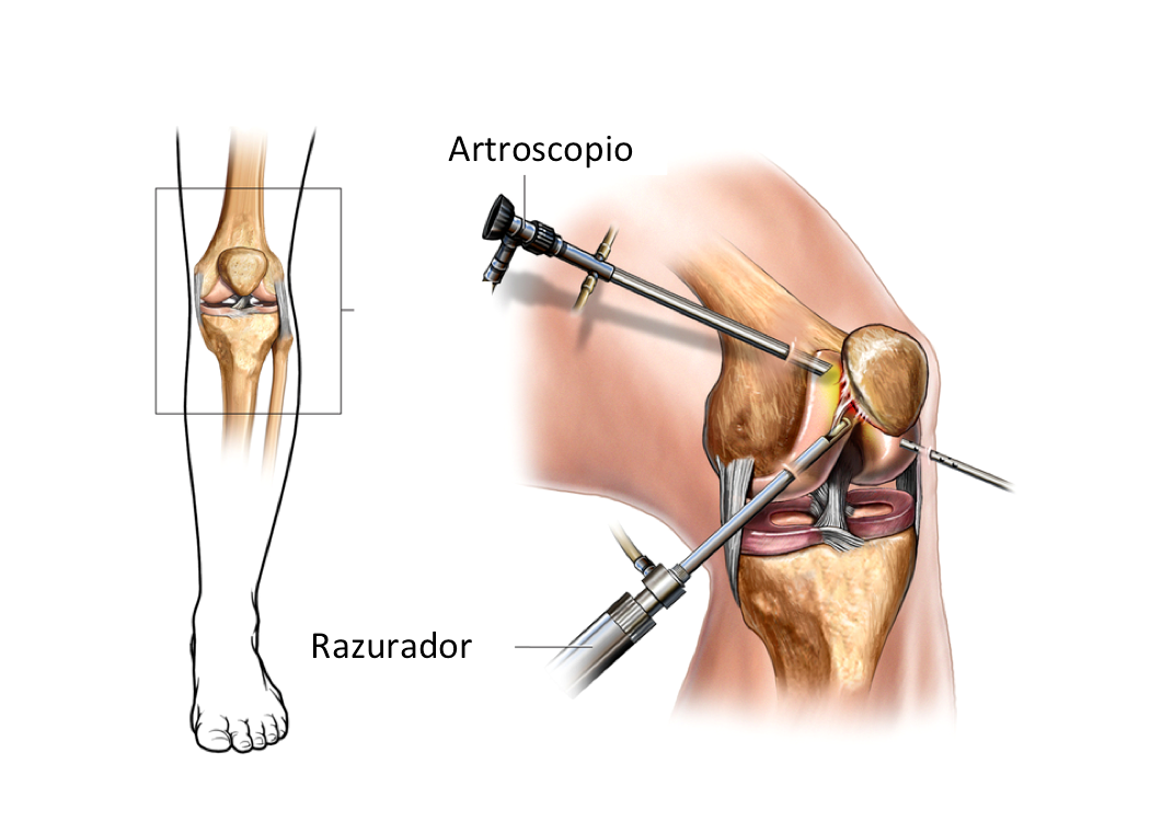 artroscopia